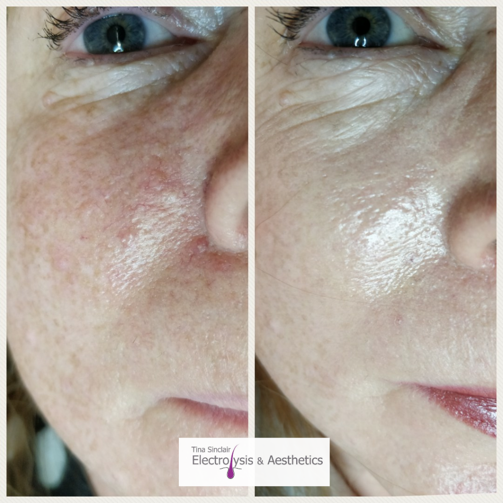 Collection 96+ Wallpaper Before And After Electrolysis Photos Full HD